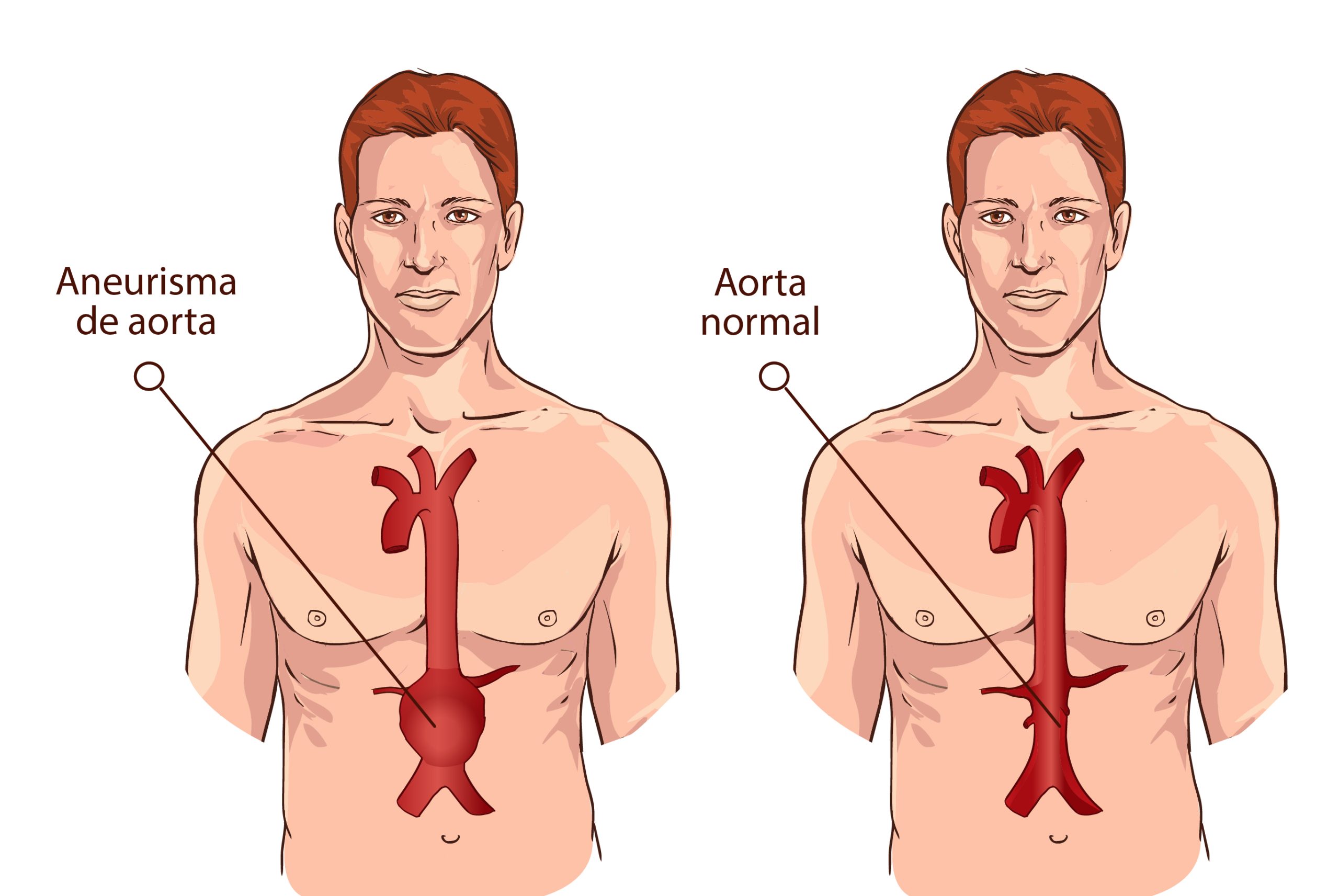 Aneurismas de Aorta Abdominal