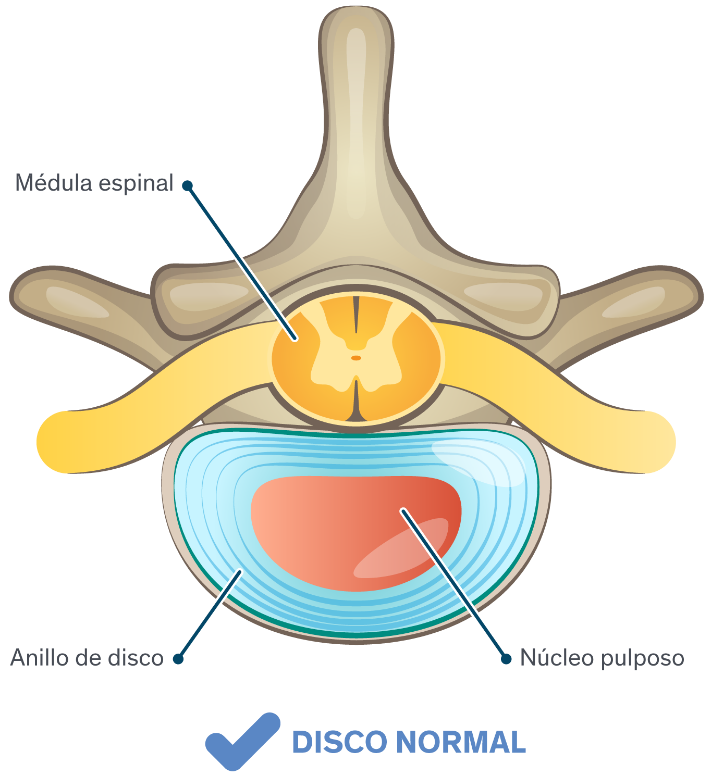 Infografía ilustrada de un disco normal en la medula espinal