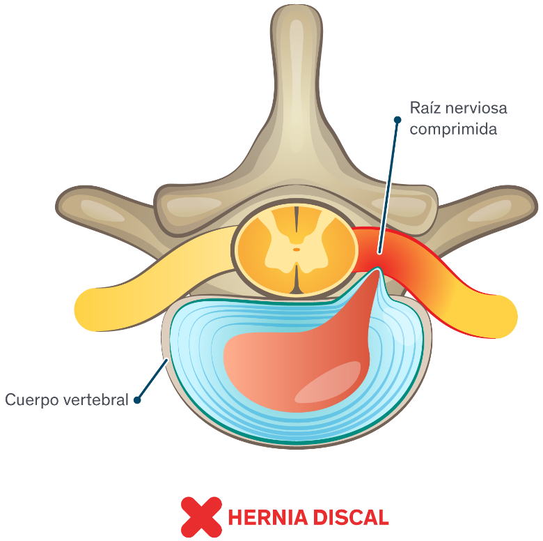 Infografía ilustrada de una hernia de disco en la medula espinal