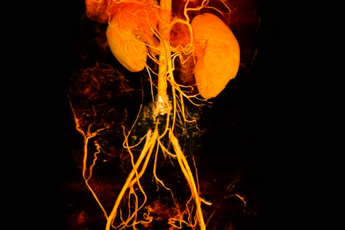 Enfermedad Arterial Obstructiva Aortoilíaca