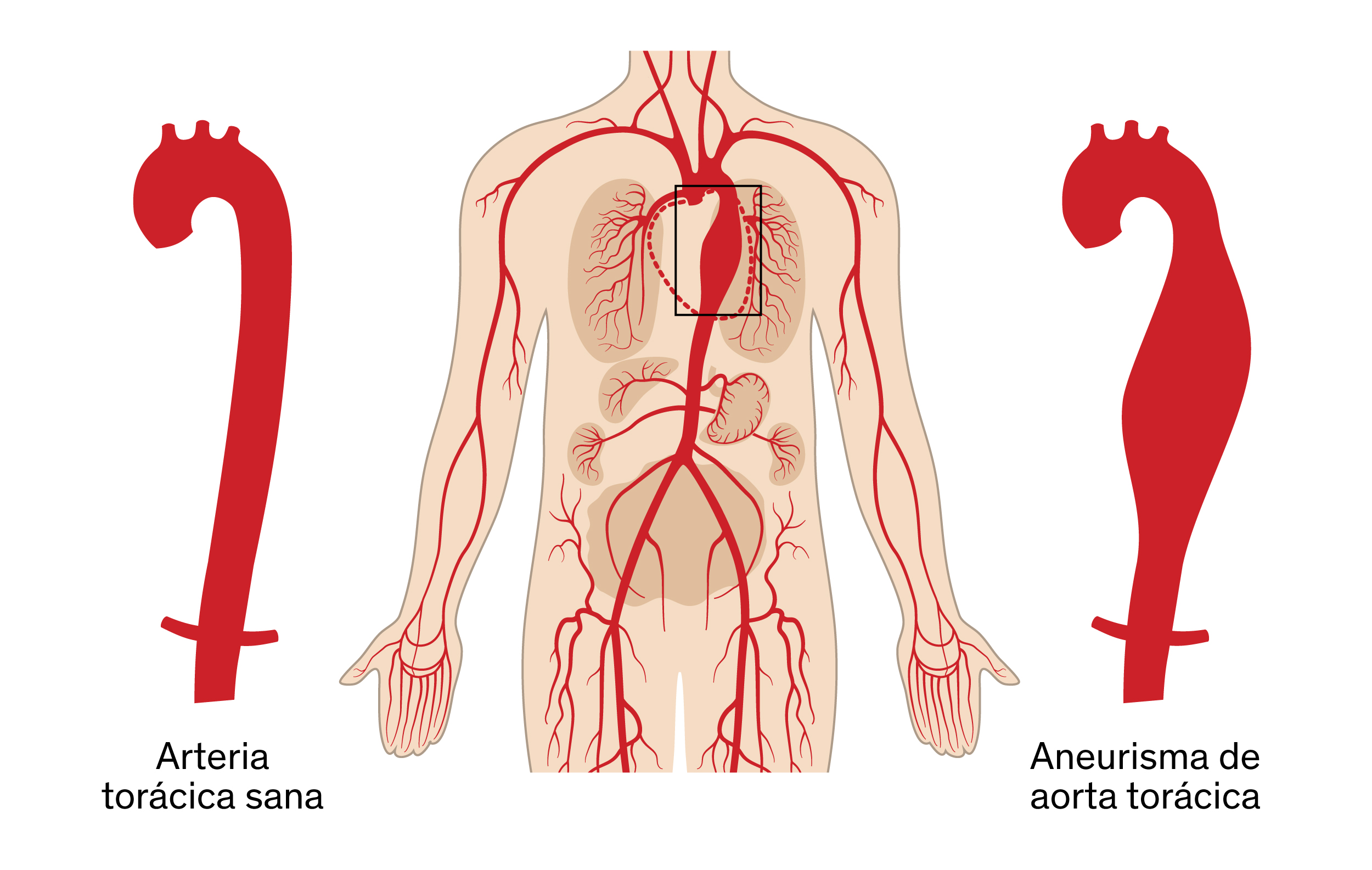 Aneurismas de aorta torácica