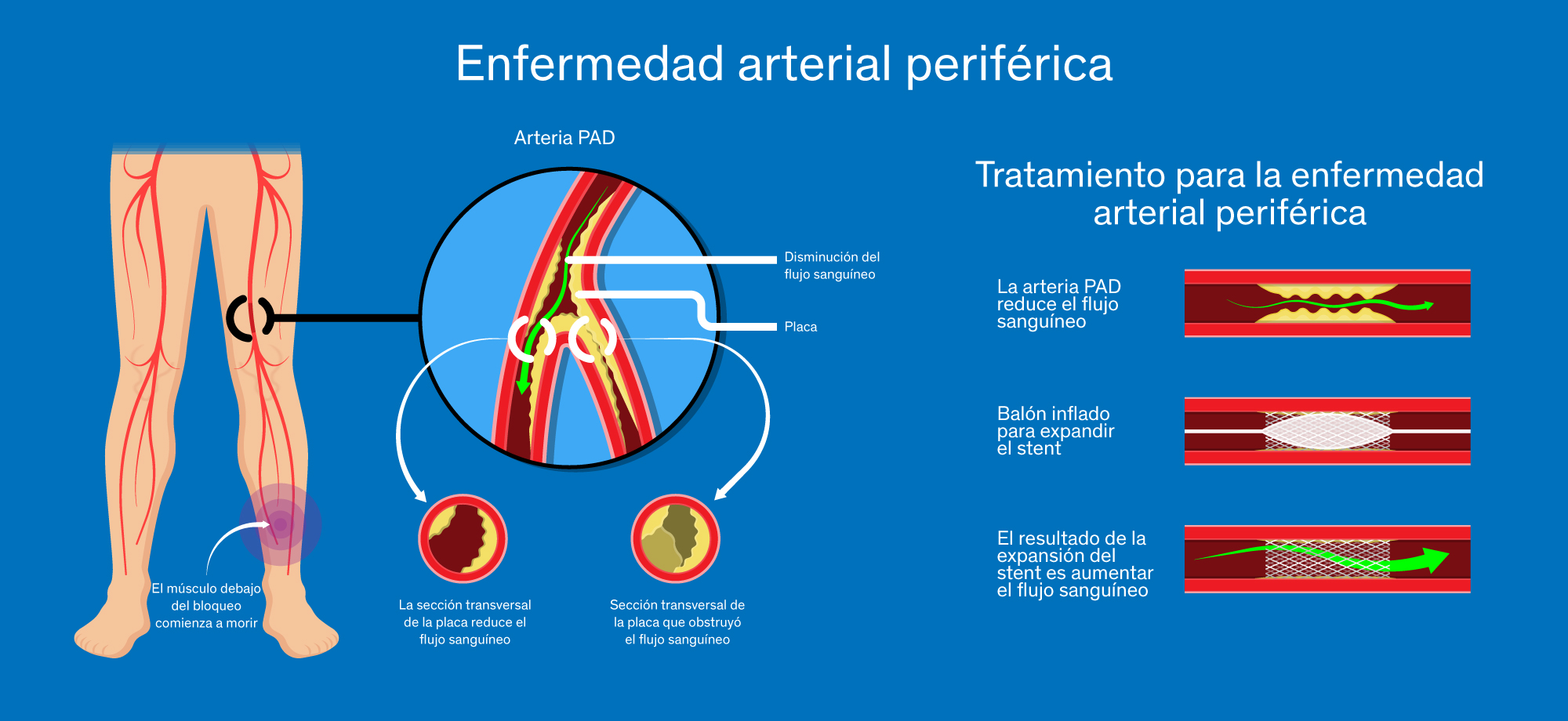 Enfermedad arterial periférica