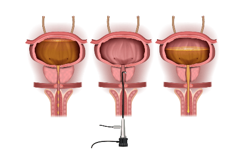 ultra transrectal