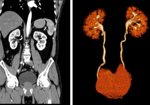 urotomografia