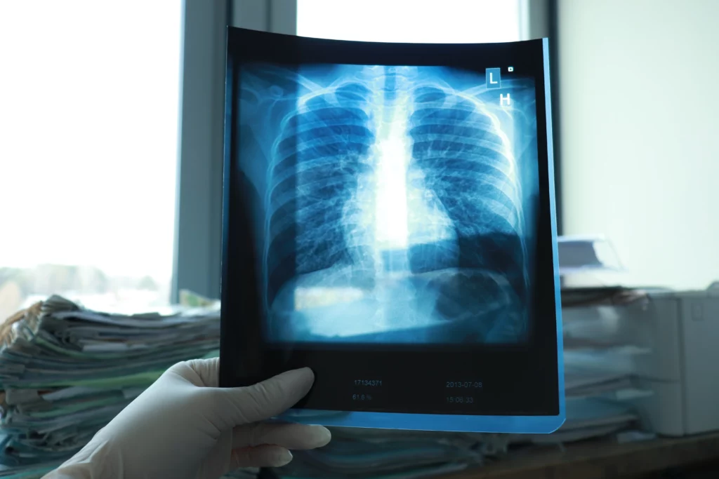 Radiografía de pulmones en búsqueda de fibrosis pulmonar