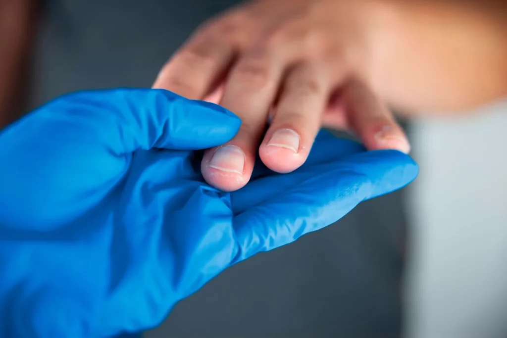 Médico revisando la dishidrosis en manos de un paciente.