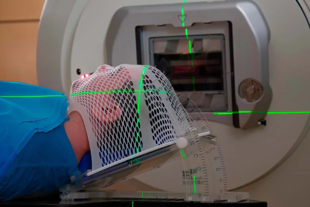 Paciente de radio-oncología recibiendo su tratamiento para el cáncer de cabeza.